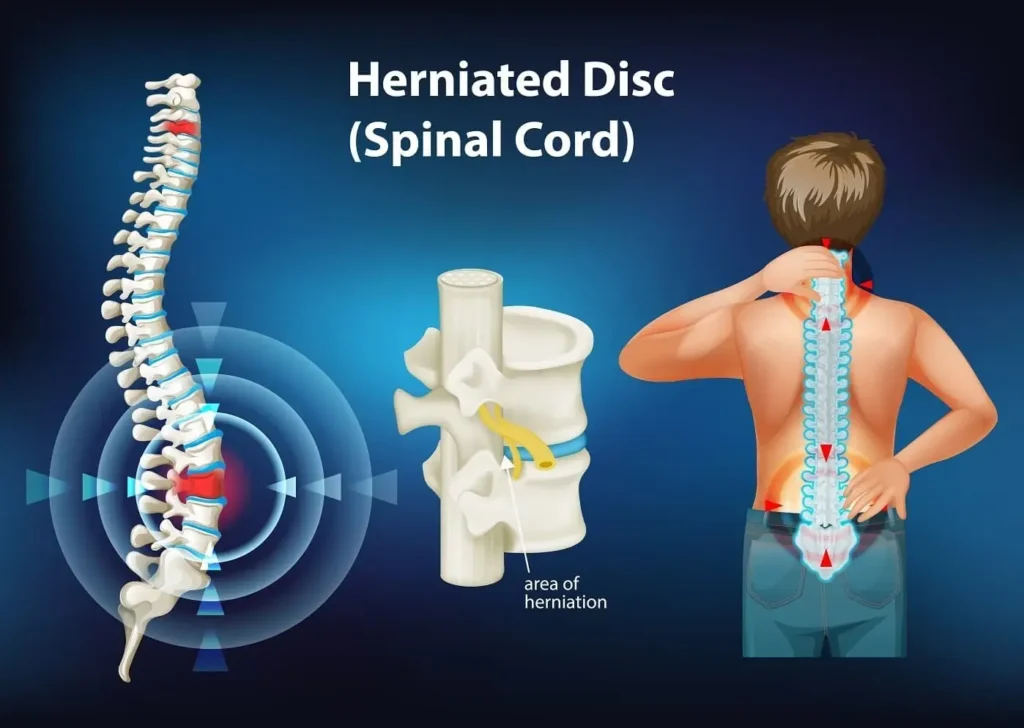 spine surgery