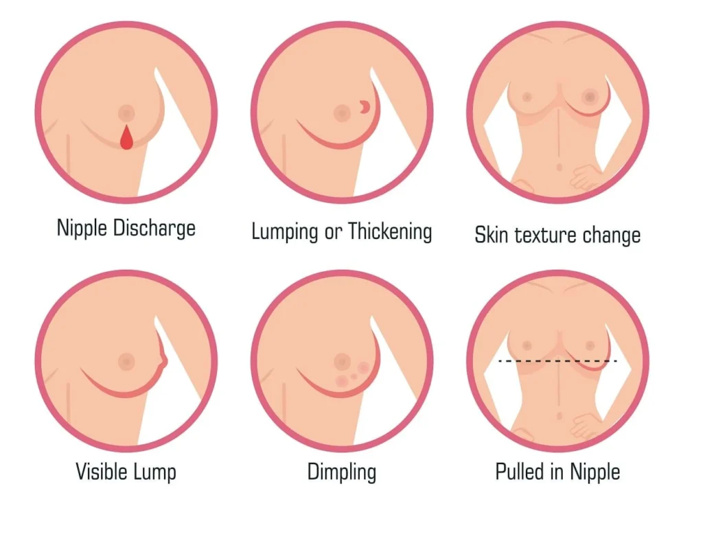 breast surgery